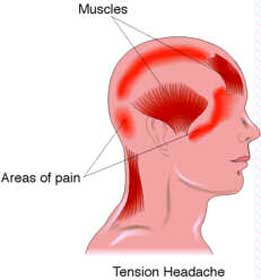 tension-headache